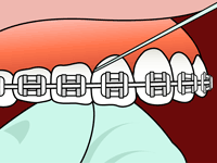 flossing diagram